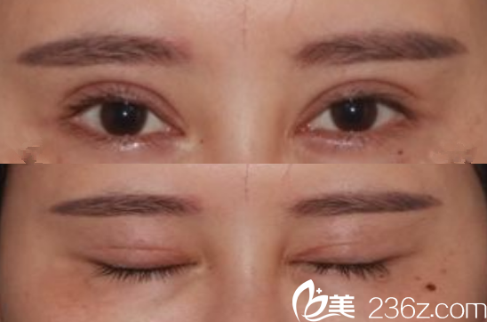 合肥艾雅整形失敗雙眼皮修復(fù)術(shù)前 合肥艾雅整形失敗雙眼皮修復(fù)術(shù)前