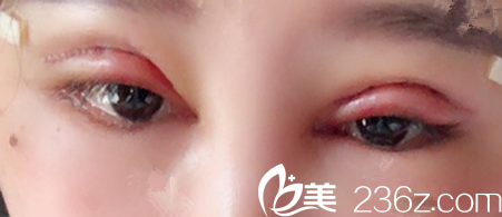 找合肥艾雅整形陸玉定做眼部失敗修復(fù)術(shù)后第3天照片 找合肥艾雅整形陸玉定做眼部失敗修復(fù)術(shù)后第3天照片