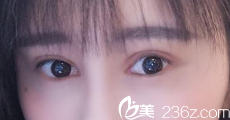 陸玉定做失敗雙眼皮修復(fù)術(shù)后第15天恢復(fù)情況 陸玉定做失敗雙眼皮修復(fù)術(shù)后第15天恢復(fù)情況