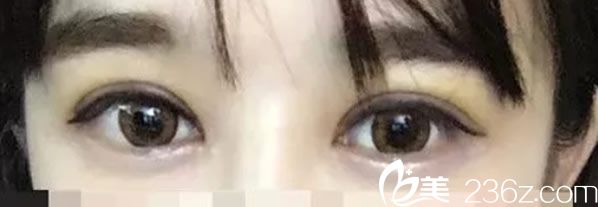 單眼皮妹子在韓國(guó)娜娜整形醫(yī)院找崔相録醫(yī)生做切開(kāi)法雙眼皮后靈動(dòng)有神