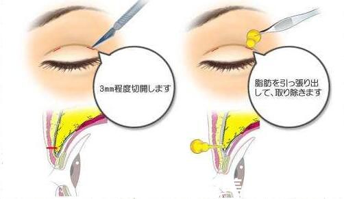 腫泡眼適合哪種雙眼皮手術(shù)方法