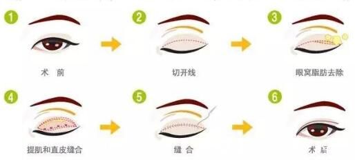 腫泡眼如何對癥治療