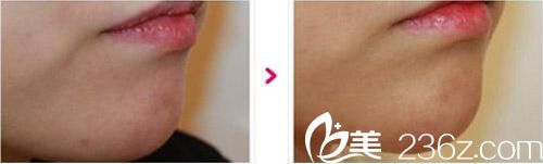 韓國(guó)多特色美整形外科自體脂肪豐下巴案例對(duì)比圖