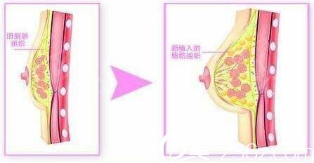 韓國(guó)Cara整形外科假體隆胸