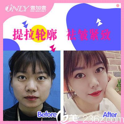 東莞壹加壹<!--<i data=20240703-sp></i>-->做的宮格拉提面部埋線提升案例