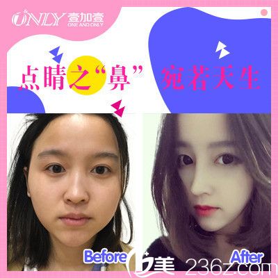 東莞壹加壹王擎做的鼻綜合隆鼻案例 東莞壹加壹王擎做的鼻綜合隆鼻案例