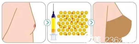 韓國(guó)Cara整形外科金賢秀自體脂肪隆胸 韓國(guó)Cara整形外科金賢秀自體脂肪隆胸