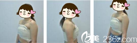 韓國Cara整形外科金賢假體隆胸真人案例術(shù)后第三天 韓國Cara整形外科金賢假體隆胸真人案例術(shù)后第三天