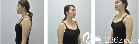 韓國Cara整形外科金賢假體隆胸真人案例術(shù)后十五天 韓國Cara整形外科金賢假體隆胸真人案例術(shù)后十五天