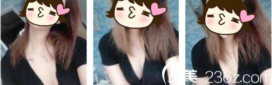 韓國Cara整形外科金賢假體隆胸真人案例術(shù)后二十一天 韓國Cara整形外科金賢假體隆胸真人案例術(shù)后二十一天