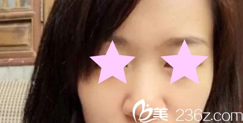 韓國愛她整形外科醫(yī)院手術(shù)前 韓國愛她整形外科醫(yī)院手術(shù)前