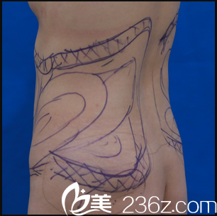 京韓王沛森院長給我做腰腹部吸脂設(shè)計照 京韓王沛森院長給我做腰腹部吸脂設(shè)計照