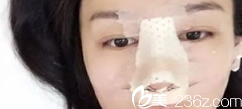 隆鼻手術(shù)第2天 隆鼻手術(shù)第2天