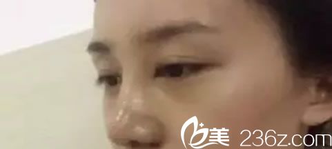 鼻子做完假體9天恢復(fù)圖 鼻子做完假體9天恢復(fù)圖