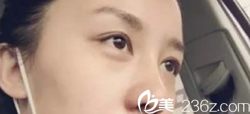 塌鼻子怎么變挺 韓國愛她整形李漢正院長假體隆鼻術(shù)讓我女神范十足