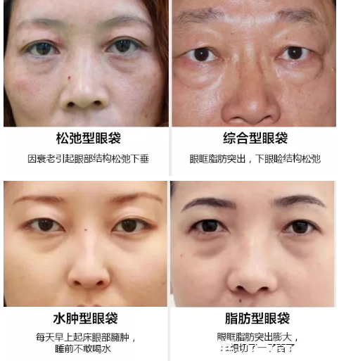 常見的幾種眼袋情況 常見的幾種眼袋情況