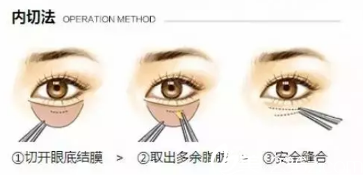 內(nèi)切法去眼袋 內(nèi)切法去眼袋