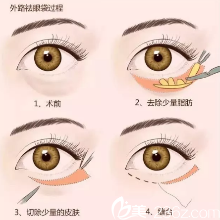 外切法去眼袋 外切法去眼袋