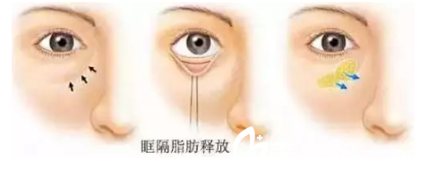 眼底眶隔脂肪重置 眼底眶隔脂肪重置