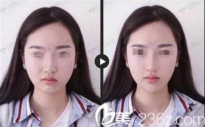 沈陽(yáng)杏林整形醫(yī)院注射隆鼻真人效果對(duì)比