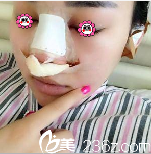 我在北京米揚(yáng)麗格做隆鼻當(dāng)天樣子 我在北京米揚(yáng)麗格做隆鼻當(dāng)天樣子