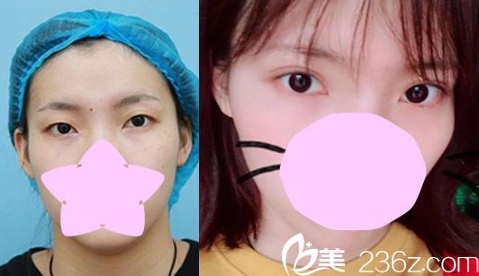 李東霖全切雙眼皮整形案例 李東霖全切雙眼皮整形案例