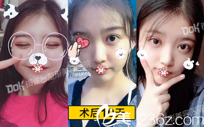 術(shù)后10天效果 術(shù)后10天效果