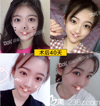 重慶銅雀臺(tái)<!--<i data=20240703-sp></i>-->做雙眼皮效果怎么樣 重慶銅雀臺(tái)<!--<i data=20240703-sp></i>-->做雙眼皮效果怎么樣