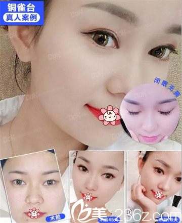 重慶銅雀臺(tái)韓式切開(kāi)雙眼皮真實(shí)案例效果對(duì)比 重慶銅雀臺(tái)韓式切開(kāi)雙眼皮真實(shí)案例效果對(duì)比