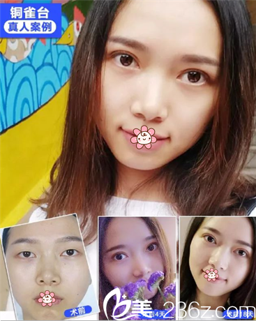 重慶銅雀臺(tái)做雙眼皮效果好不好 重慶銅雀臺(tái)做雙眼皮效果好不好