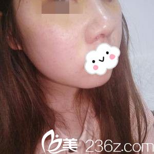 自體軟骨隆鼻第8天 自體軟骨隆鼻第8天