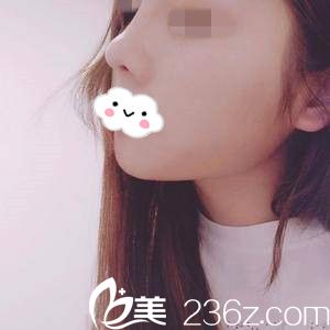 隆鼻半個月后的效果 隆鼻半個月后的效果