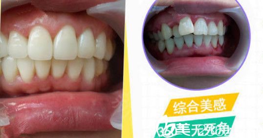 秦洪章牙齒半隱形矯正案例