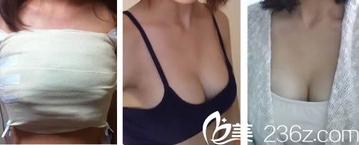 韓國愛我整形樸范鎮(zhèn)院長給做假體隆胸的當天照和術后兩個月照