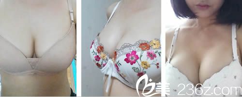 我終于去韓國人認(rèn)可的整容醫(yī)院—韓國愛我整形讓樸范鎮(zhèn)院長做了曼托毛面假體隆胸