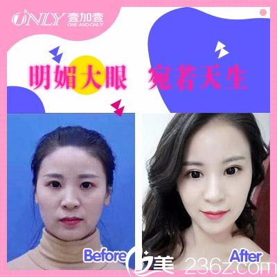 東莞壹加壹王擎院長(zhǎng)做的雙眼皮案例 東莞壹加壹王擎院長(zhǎng)做的雙眼皮案例