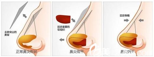 韓國(guó)AURORA整形外科醫(yī)院李志永鷹鉤鼻矯正