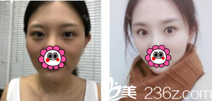 玻尿酸墊下巴案例對(duì)比圖