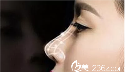 耳軟骨多用于墊鼻尖和鼻小柱