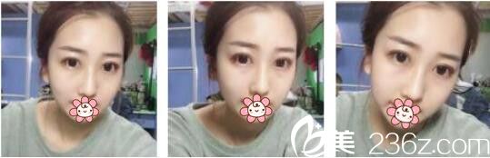 韓國AURORA整形外科醫(yī)院李志永鼻綜合真人案例術(shù)后十八天 韓國AURORA整形外科醫(yī)院李志永鼻綜合真人案例術(shù)后十八天