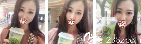 訴說我去韓國AURORA找李志永做鼻綜合三個月的恢復(fù)心里路程