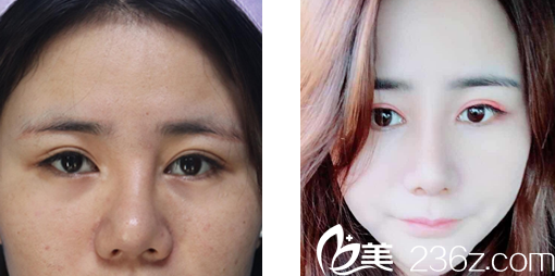 呼和浩特京美鼻綜合隆鼻效果案例