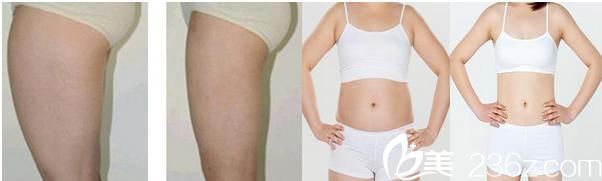 抽脂對(duì)比案例