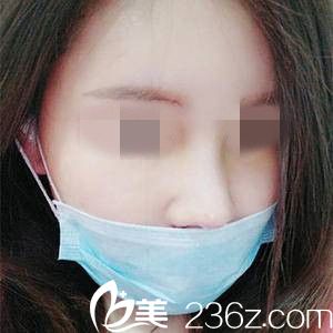 鼻修復(fù)一周后的效果 鼻修復(fù)一周后的效果