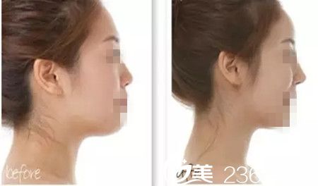 線雕隆鼻案例 線雕隆鼻案例