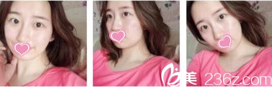 韓國奧拉克皮膚科整外科李正馥面部提升真人案例術(shù)前照 韓國奧拉克皮膚科整外科李正馥面部提升真人案例術(shù)前照