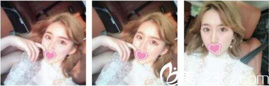 韓國奧拉克皮膚科整外科李正馥面部提升真人案例術(shù)后第七天 韓國奧拉克皮膚科整外科李正馥面部提升真人案例術(shù)后第七天