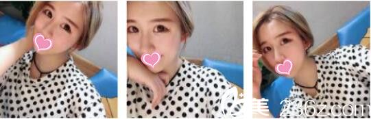 韓國奧拉克皮膚科整外科李正馥面部提升真人案例術(shù)后一個月 韓國奧拉克皮膚科整外科李正馥面部提升真人案例術(shù)后一個月