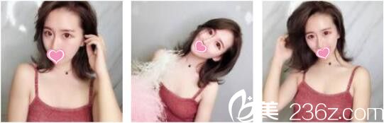 都說(shuō)李正馥做提升效果好價(jià)格公道，于是我到韓國(guó)奧拉克做了面部埋線提升