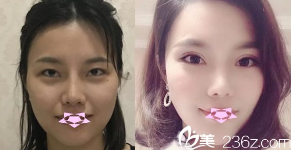 合肥壹美尚雙眼皮失敗修復(fù)案例 合肥壹美尚雙眼皮失敗修復(fù)案例